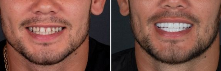hollywood-smile-before-after-photo