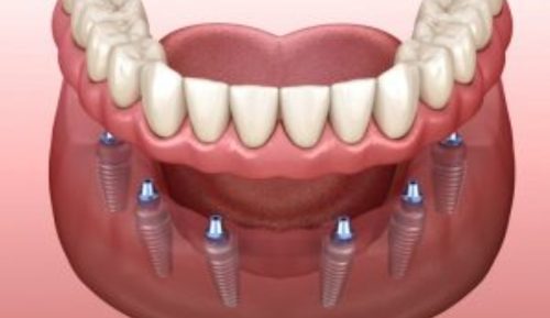 All On 6 Dental Implants