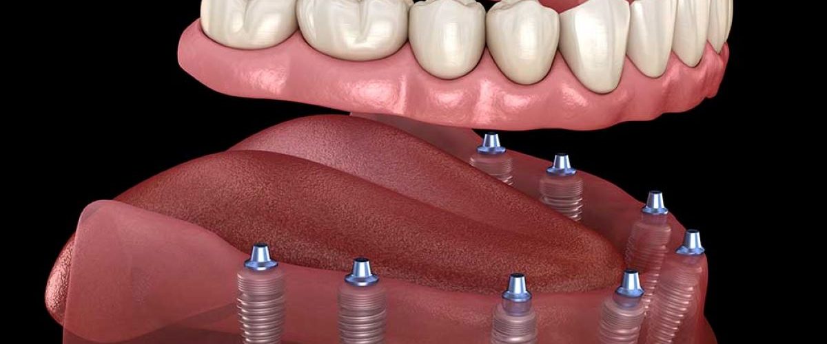 full-mouth-implant-treatment
