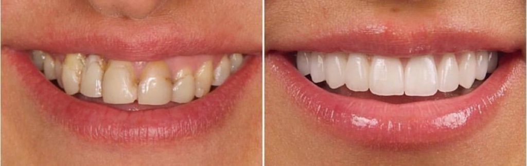 hollywood-smile-before-after