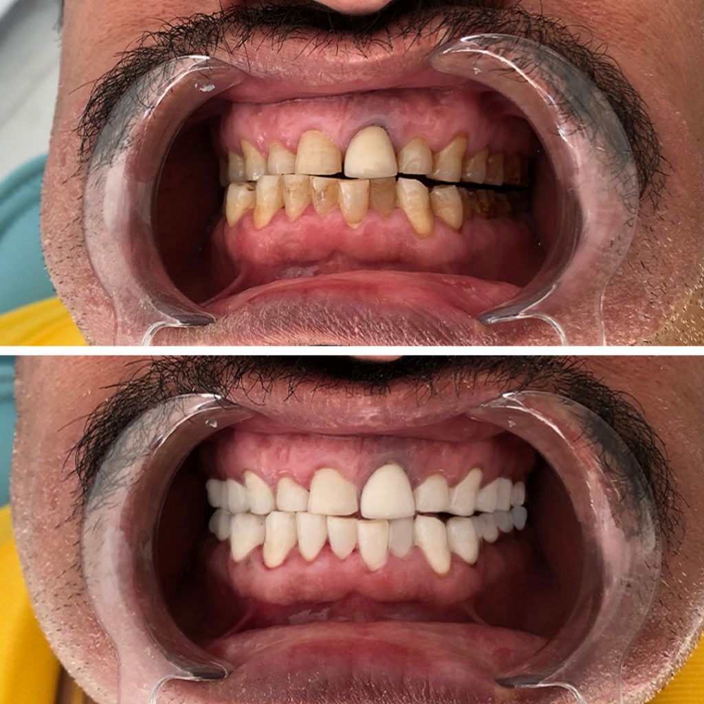 teeth-whitening-2