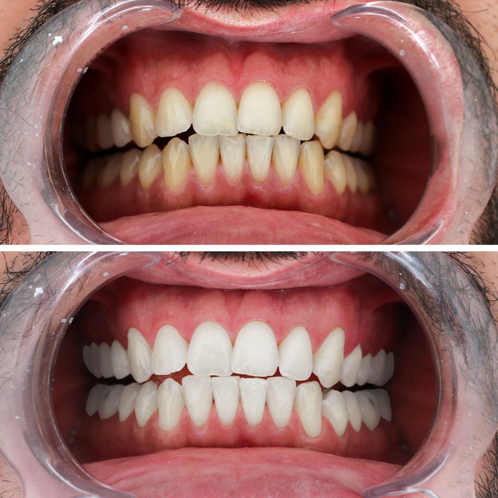 teeth-whitening.-1jpg