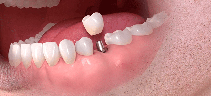 Dental Implants Turkey