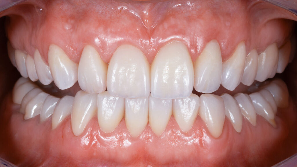 Monolithic Zirconia Crowns