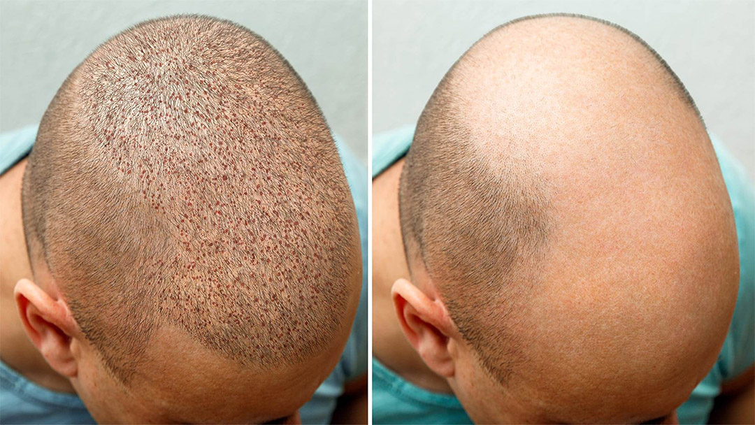 Hair Transplant in istanbul turkey 3